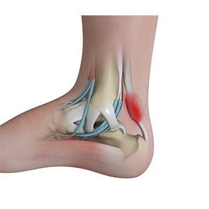 Achilles Tendonitis pic