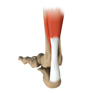 Achilles Tendon Reconstruction pic