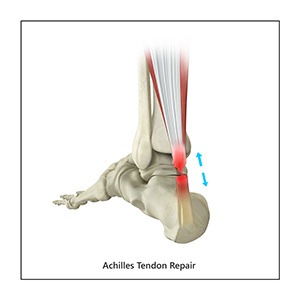 Achilles Tendon Repair pic