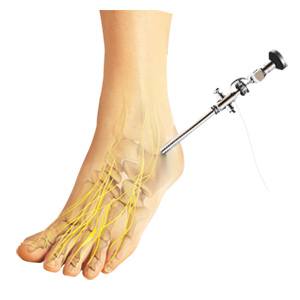 Ankle Arthroscopy pic