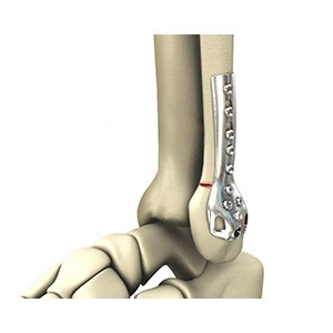 Ankle Fracture Surgery pic
