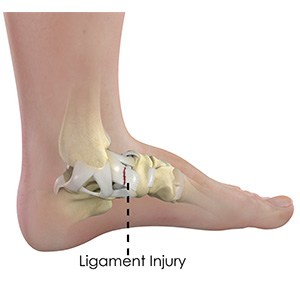 Ankle Ligament Injury pic