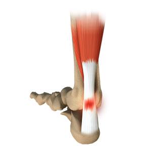 Ankle Tendonitis pic