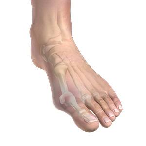 Bunion pic