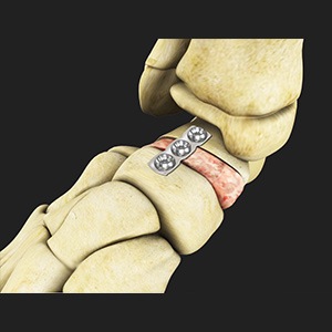 Flatfoot Reconstruction pic