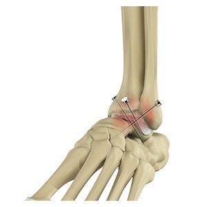 Foot and Ankle Surgery pic