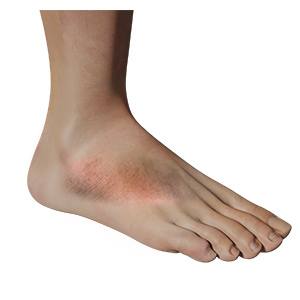 Foot Inflammation pic