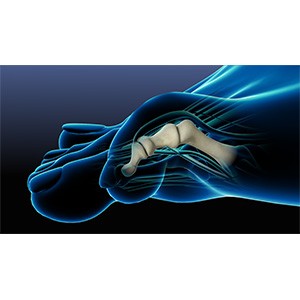 Lesser Toe Deformities pic