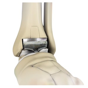 Revision Foot and Ankle Surgery pic