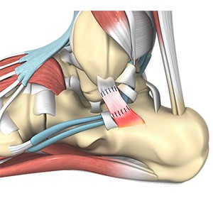 Revision Total Ankle Replacement pic
