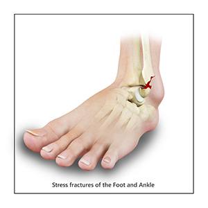 Stress Fractures of Foot and Ankle pic