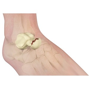 Talus Fractures pic