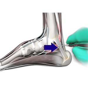 Tarsal Tunnel Syndrome pic
