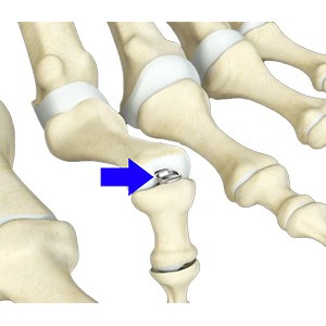 Toe Deformity Correction pic