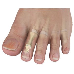 Toe Fractures pic