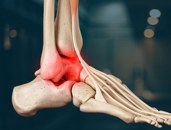 Ankle Arthropathy Pic