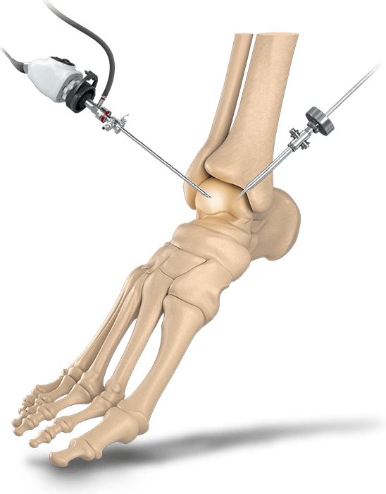 Minimally Invasive Foot & Ankle Reconstruction Pic