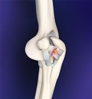 elbow-ligament-reconstruction-img