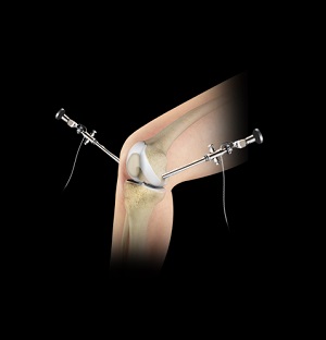 Knee Arthroscopy