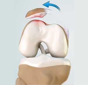 patellofemoral-instability-img