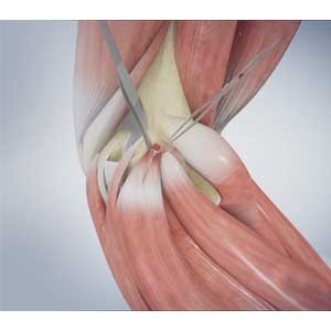 Golfer's  Elbow Surgery  pic