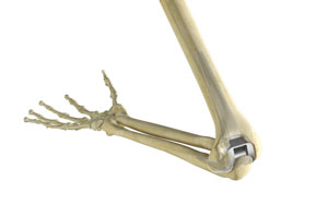 Total Elbow Replacement pic