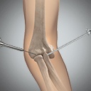 Elbow Arthroscopy