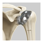 Shoulder Arthroscopy