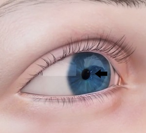 Conjunctival and Corneal tear pic