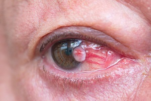 Diseases of Cornea pic