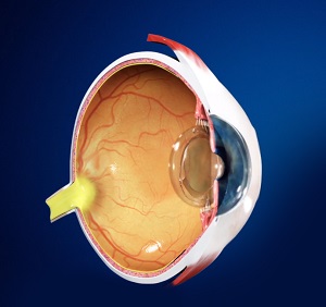 Intraocular Lens (IOL) pic