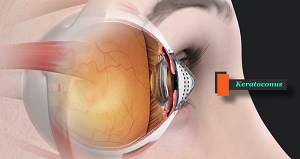 Keratoconus pic