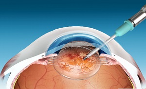 Laser-Assisted Cataract Surgery pic