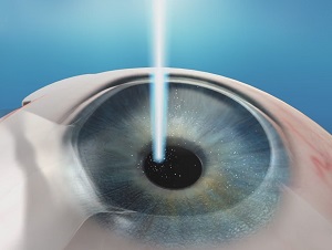 LASIK (laser in-situ keratomileusis) pic