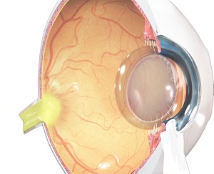 Light Adjustable Intraocular Lens pic