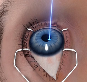 Photorefractive Keratectomy (PRK) pic