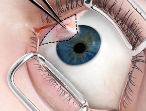 Pterygium Surgery pic