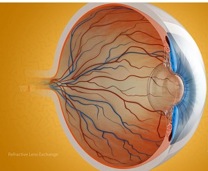 Refractive Lens Exchange pic