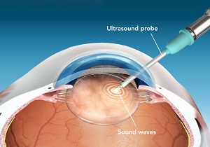 Treatment for Cataract pic