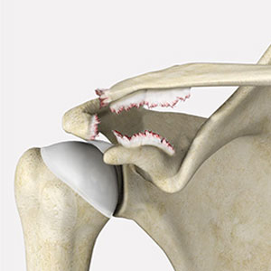 AC Joint Separation - Educational Photo