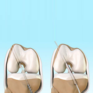 ACL Reconstruction - Educational Photo