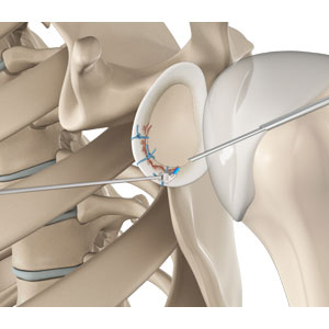 Arthroscopic Bankart Repair - Educational Photo