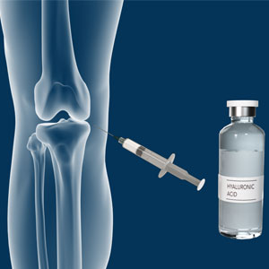 Hyaluronic Acid Injections - Educational Photo