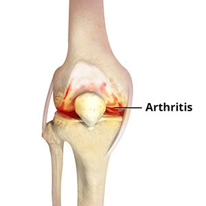 Knee Arthritis - Educational Photo