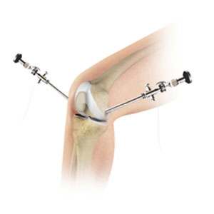 Knee Arthroscopy - Educational Photo