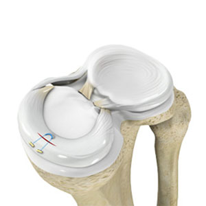 Meniscal Repair Surgery - Educational Photo