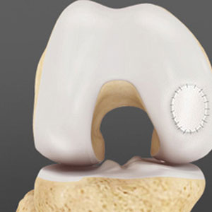 Orthobiologics for the Knee - Educational Photo