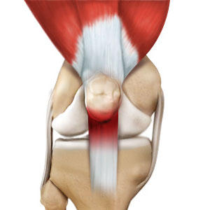 Patellar Tendonitis - Educational Photo