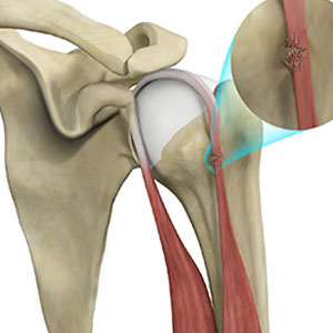 Proximal Biceps Tendon Rupture - Educational Photo