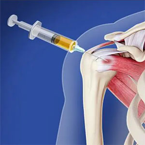 Platelet-Rich Plasma (PRP) for the Shoulder - Educational Photo